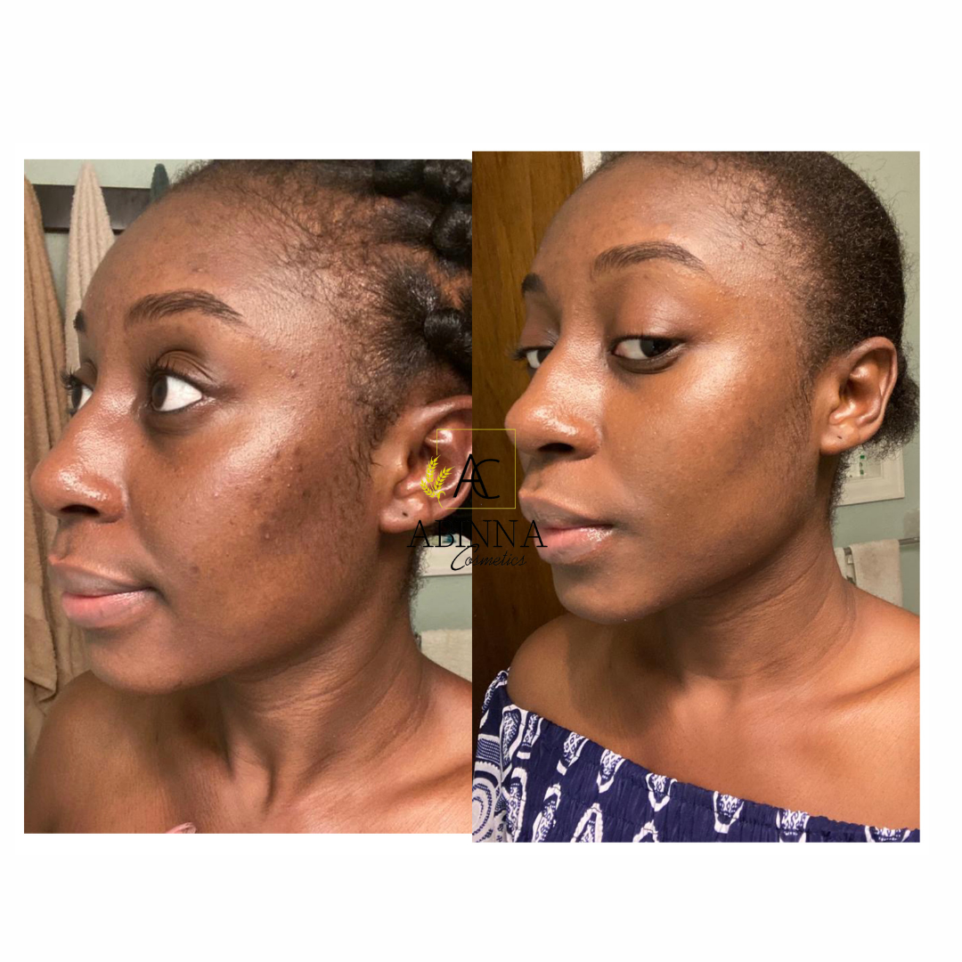 Acne Essential Kit (5 STEPS TO A FLAWLESS, GLOWING SKIN) - Abinna Cosmetics